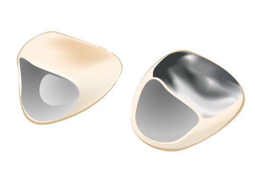 硬質レジン前装冠(前歯のみのクラウン)